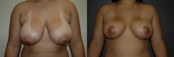 Breast Reduction before and after photo by Dr. Richard A. Bartlett in Brookline, MA
