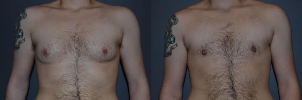 Gender Affirming Surgery before and after photo by Dr. Richard A. Bartlett in Brookline, MA