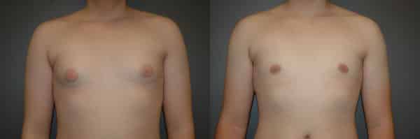 Gynecomastia (Male Breast Reduction) before and after photo by Dr. Richard A. Bartlett in Brookline, MA