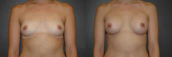 Breast Augmentation before and after photo by Dr. Richard A. Bartlett in Brookline, MA