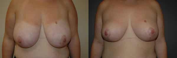 Breast Reduction before and after photo by Dr. Richard A. Bartlett in Brookline, MA