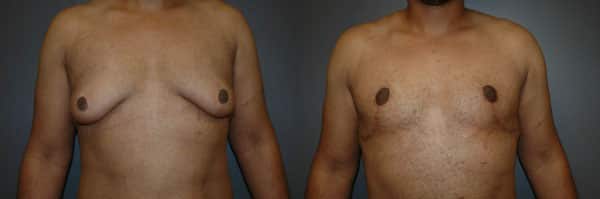 Gynecomastia (Male Breast Reduction) before and after photo by Dr. Richard A. Bartlett in Brookline, MA