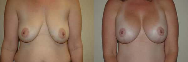 Breast Augmentation before and after photo by Dr. Richard A. Bartlett in Brookline, MA