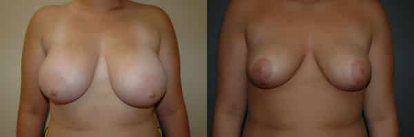Breast Reduction before and after photo by Dr. Richard A. Bartlett in Brookline, MA
