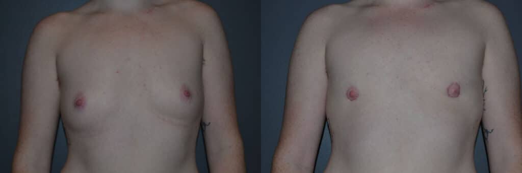 Gender Affirming Surgery before and after photo by Dr. Richard A. Bartlett in Brookline, MA