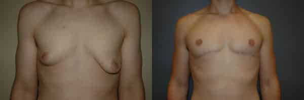Gynecomastia (Male Breast Reduction) before and after photo by Dr. Richard A. Bartlett in Brookline, MA