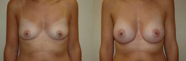 Breast Augmentation before and after photo by Dr. Richard A. Bartlett in Brookline, MA