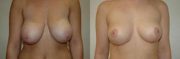 Breast Reduction before and after photo by Dr. Richard A. Bartlett in Brookline, MA
