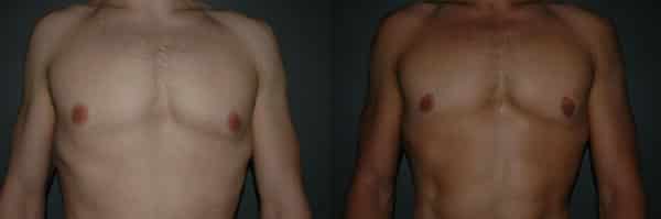 Gynecomastia (Male Breast Reduction) before and after photo by Dr. Richard A. Bartlett in Brookline, MA