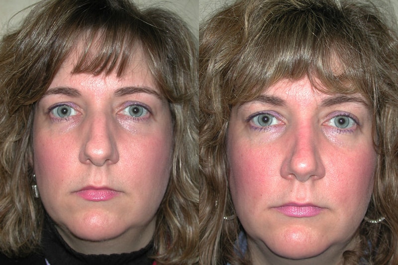 Rhinoplasty (Nose Surgery) before and after photo by Dr. Richard A. Bartlett in Brookline, MA