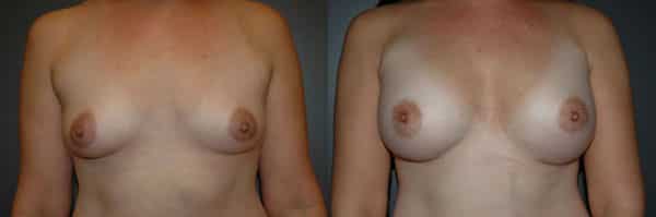 Breast Augmentation before and after photo by Dr. Richard A. Bartlett in Brookline, MA