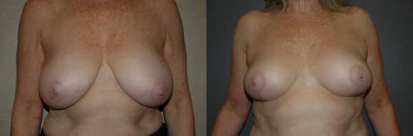 Breast Reduction before and after photo by Dr. Richard A. Bartlett in Brookline, MA