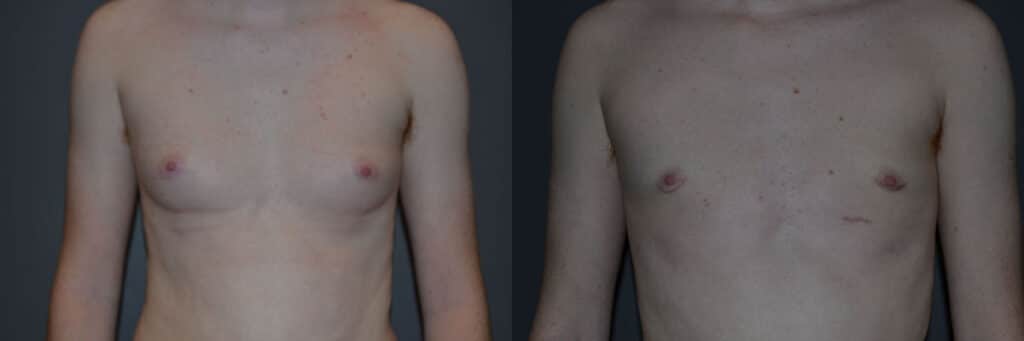 Gender Affirming Surgery before and after photo by Dr. Richard A. Bartlett in Brookline, MA