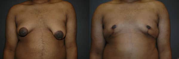 Gynecomastia (Male Breast Reduction) before and after photo by Dr. Richard A. Bartlett in Brookline, MA