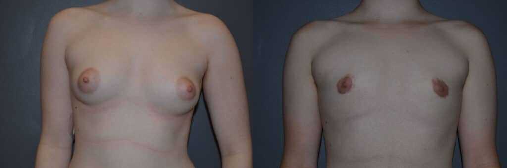 Gender Affirming Surgery before and after photo by Dr. Richard A. Bartlett in Brookline, MA