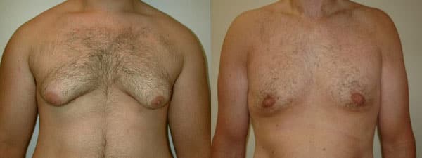 Gynecomastia (Male Breast Reduction) before and after photo by Dr. Richard A. Bartlett in Brookline, MA