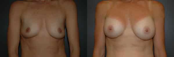 Breast Augmentation before and after photo by Dr. Richard A. Bartlett in Brookline, MA