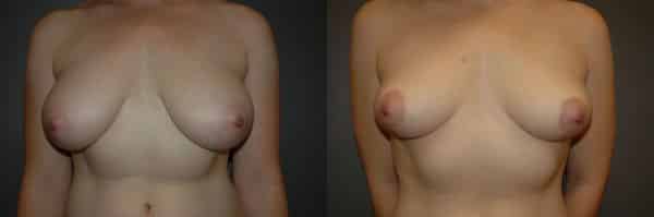 Breast Reduction before and after photo by Dr. Richard A. Bartlett in Brookline, MA