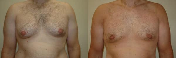 Gynecomastia (Male Breast Reduction) before and after photo by Dr. Richard A. Bartlett in Brookline, MA