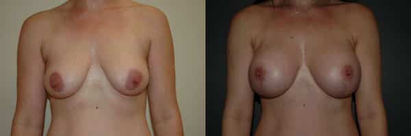 Breast Augmentation before and after photo by Dr. Richard A. Bartlett in Brookline, MA