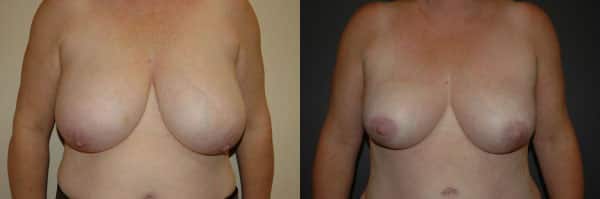 Breast Reduction before and after photo by Dr. Richard A. Bartlett in Brookline, MA