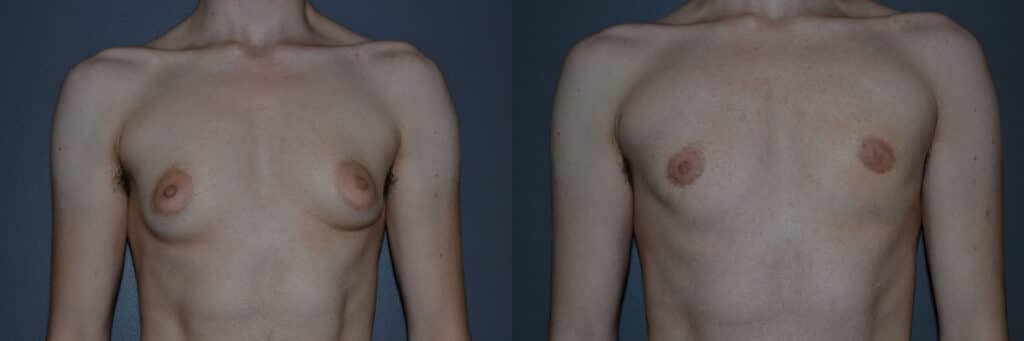 Gender Affirming Surgery before and after photo by Dr. Richard A. Bartlett in Brookline, MA