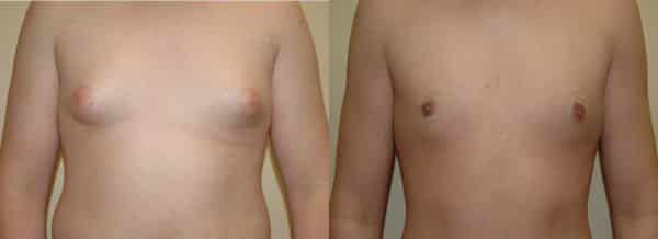 Gynecomastia (Male Breast Reduction) before and after photo by Dr. Richard A. Bartlett in Brookline, MA