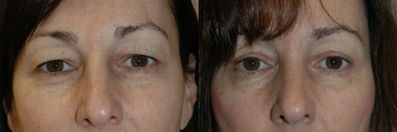 Blepharoplasty (Eyelid Surgery) before and after photo by Dr. Richard A. Bartlett in Brookline, MA