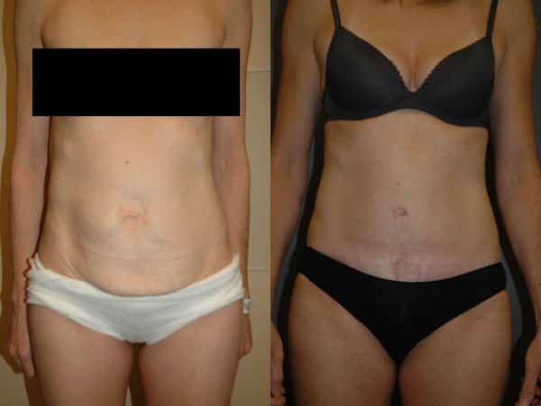 Abdominoplasty (Tummy Tuck) before and after photo by Dr. Richard A. Bartlett in Brookline, MA