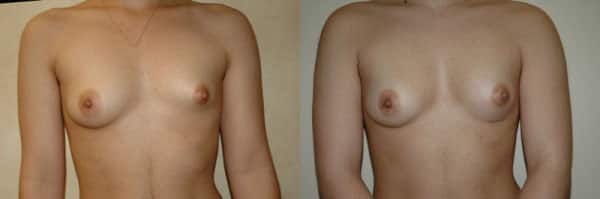 Breast Asymmetry before and after photo by Dr. Richard A. Bartlett in Brookline, MA