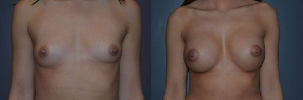 Breast Augmentation before and after photo by Dr. Richard A. Bartlett in Brookline, MA