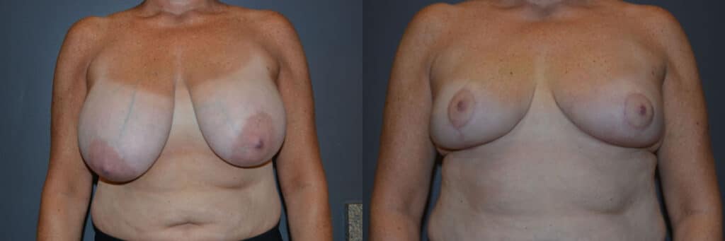 Breast Reduction before and after photo by Dr. Richard A. Bartlett in Brookline, MA