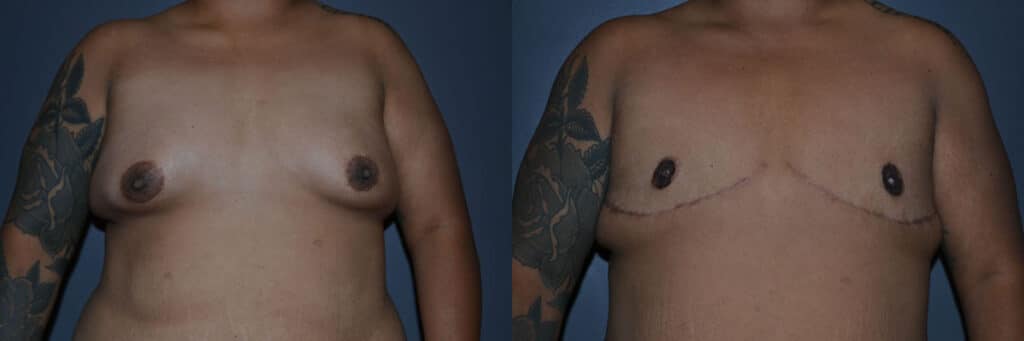 Gender Affirming Surgery before and after photo by Dr. Richard A. Bartlett in Brookline, MA
