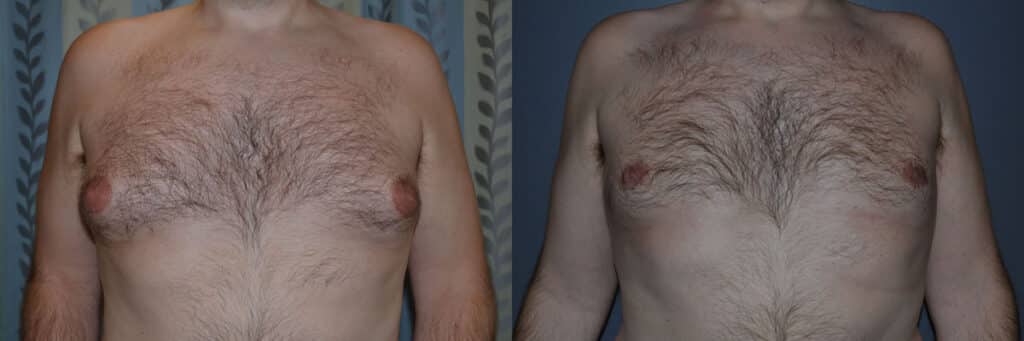 Gynecomastia (Male Breast Reduction) before and after photo by Dr. Richard A. Bartlett in Brookline, MA