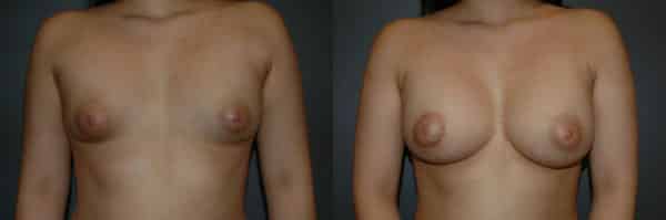 Breast Augmentation before and after photo by Dr. Richard A. Bartlett in Brookline, MA