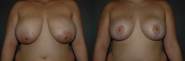 Breast Reduction before and after photo by Dr. Richard A. Bartlett in Brookline, MA