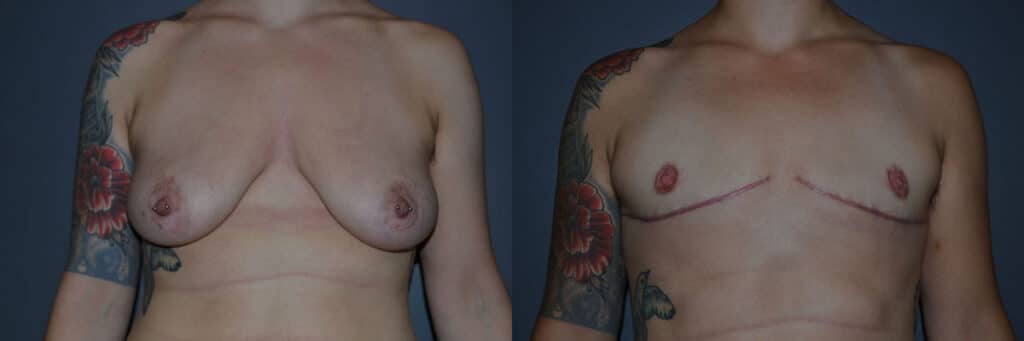 Gender Affirming Surgery before and after photo by Dr. Richard A. Bartlett in Brookline, MA