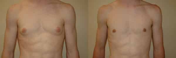 Gynecomastia (Male Breast Reduction) before and after photo by Dr. Richard A. Bartlett in Brookline, MA