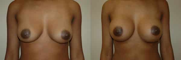 Breast Augmentation before and after photo by Dr. Richard A. Bartlett in Brookline, MA