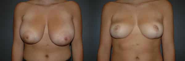 Breast Reduction before and after photo by Dr. Richard A. Bartlett in Brookline, MA