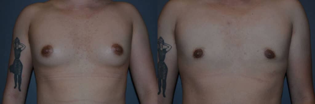 Gender Affirming Surgery before and after photo by Dr. Richard A. Bartlett in Brookline, MA