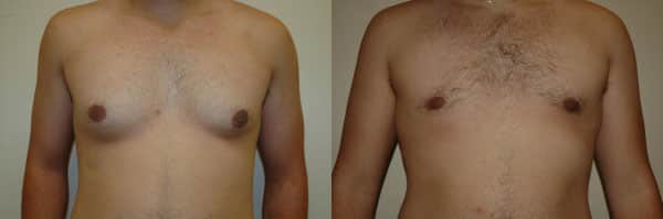 Gynecomastia (Male Breast Reduction) before and after photo by Dr. Richard A. Bartlett in Brookline, MA