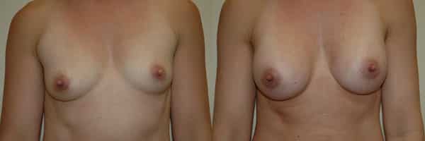 Breast Augmentation before and after photo by Dr. Richard A. Bartlett in Brookline, MA