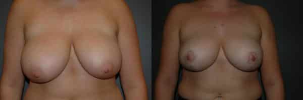 Breast Reduction before and after photo by Dr. Richard A. Bartlett in Brookline, MA