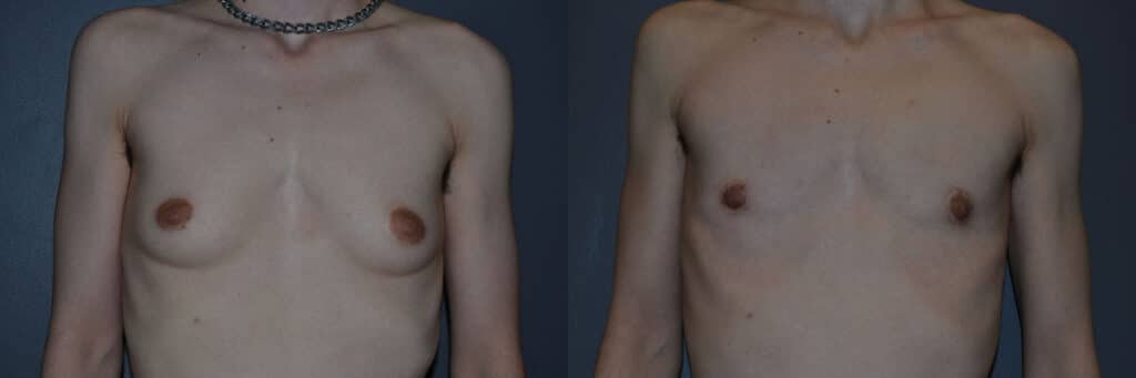 Gender Affirming Surgery before and after photo by Dr. Richard A. Bartlett in Brookline, MA