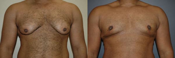 Gynecomastia (Male Breast Reduction) before and after photo by Dr. Richard A. Bartlett in Brookline, MA