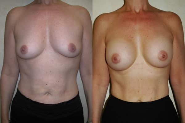 Breast Augmentation before and after photo by Dr. Richard A. Bartlett in Brookline, MA