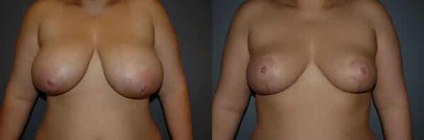 Breast Reduction before and after photo by Dr. Richard A. Bartlett in Brookline, MA