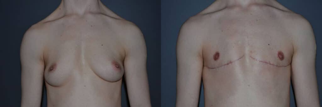 Gender Affirming Surgery before and after photo by Dr. Richard A. Bartlett in Brookline, MA