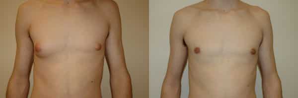 Gynecomastia (Male Breast Reduction) before and after photo by Dr. Richard A. Bartlett in Brookline, MA